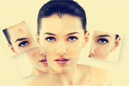 祛痘也要將就方法，不然后果很嚴(yán)重