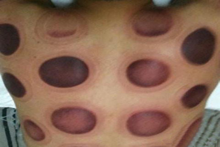 拔罐留下的印記有何含義?看印記辨別健康 拔罐留下的印記有何含義?看印記辨別健康