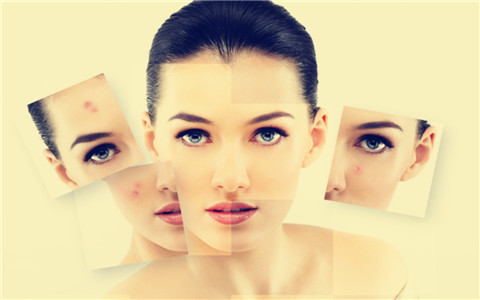 胸口長(zhǎng)痘痘怎么消除