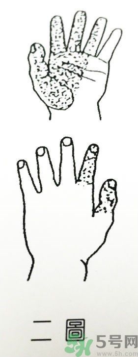 經(jīng)常手麻腳麻是怎么回事 4種疾病的前兆 經(jīng)常手麻腳麻是怎么回事 4種疾病的前兆