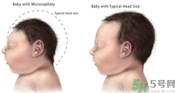 寨卡病毒是不是與基因突變有關(guān)系? 寨卡病毒是不是與基因突變有關(guān)系?