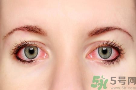 流感咳嗽導(dǎo)致眼睛出血怎么辦?眼睛出血嚴(yán)重嗎? 流感咳嗽導(dǎo)致眼睛出血怎么辦?眼睛出血嚴(yán)重嗎?