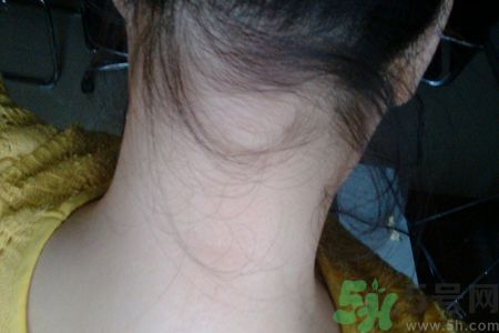 脖子后面長痘痘是什么原因?脖子后面長痘痘怎么治療 脖子后面長痘痘是什么原因?脖子后面長痘痘怎么治療