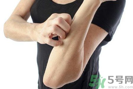 皮膚炎癢是怎么回事？皮膚炎發(fā)作怎么治療？