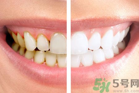 牙齒有黃斑怎么辦？牙齒有黃斑怎么去除？