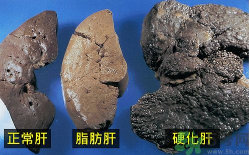 得了脂肪肝該怎么治？脂肪肝對人體危害有多大？