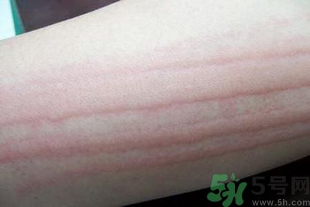 蕁麻疹會(huì)不會(huì)傳染？蕁麻疹怎么治才能好？