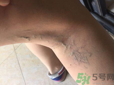 40歲女性小腿靜脈曲張怎么辦？