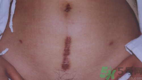 剖腹產(chǎn)疤痕怎么修復?剖腹產(chǎn)如何護理不留疤痕?.jpg