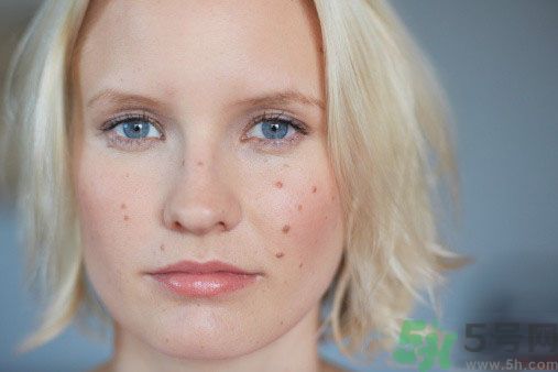 為什么會(huì)長(zhǎng)痘痘？痘痘有哪幾種類型的？