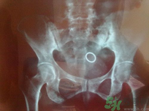 脊柱炎分幾種?脊柱炎能治好嗎 脊柱炎分幾種?脊柱炎能治好嗎