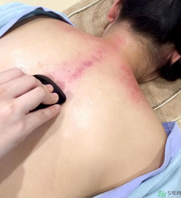 刮痧的好處有那些？夏季刮痧要注意什么？