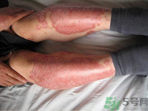 紫外線過敏怎么辦?紫外線過敏能根治嗎 紫外線過敏怎么辦?紫外線過敏能根治嗎