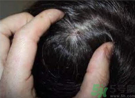 頭皮上長痘痘是什么原因?頭皮上長痘痘怎么治 頭皮上長痘痘是什么原因?頭皮上長痘痘怎么治