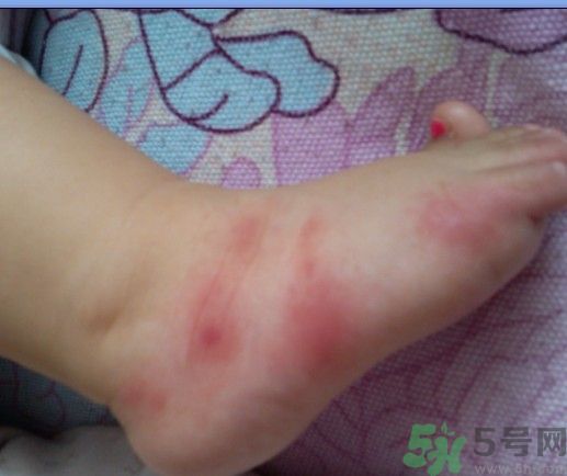 被蚊子咬了起紅點(diǎn)怎么消除?被蚊子咬會(huì)得什么病 被蚊子咬了起紅點(diǎn)怎么消除?被蚊子咬會(huì)得什么病