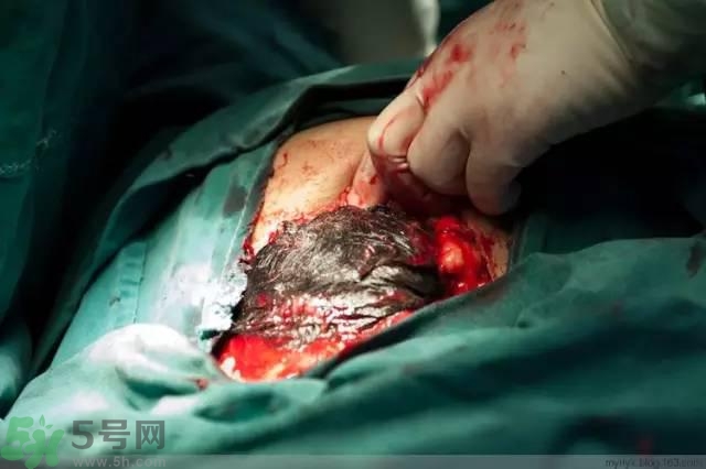 剖腹產(chǎn)傷口多久愈合?剖腹產(chǎn)傷口怎么恢復(fù)的快 剖腹產(chǎn)傷口多久愈合?剖腹產(chǎn)傷口怎么恢復(fù)的快