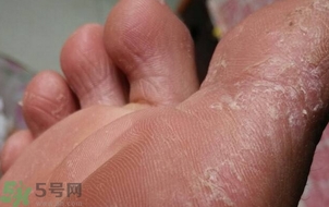 夏天腳脫皮用什么藥?夏天腳脫皮用什么泡腳? 夏天腳脫皮用什么藥?夏天腳脫皮用什么泡腳?