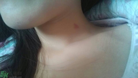 種草莓吻痕是什么意思？吻痕是怎么弄出來的？