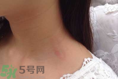 種草莓吻痕是什么意思？吻痕是怎么弄出來的？