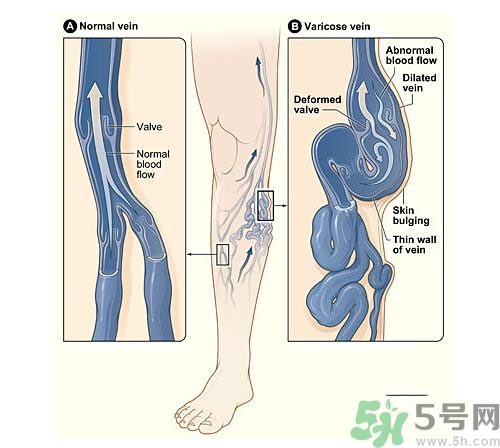 什么樣的人容易得筋脈曲張？靜脈曲張的原因