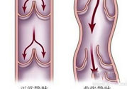 什么樣的人容易得筋脈曲張？靜脈曲張的原因