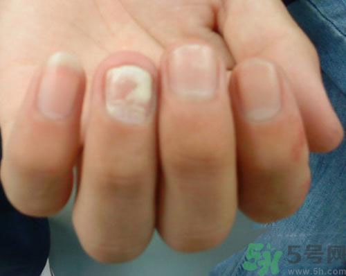 指甲發(fā)白是怎么回事？指甲發(fā)白代表什么？