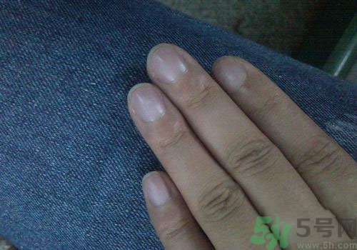 指甲發(fā)紫是什么原因？指甲發(fā)紫是怎么回事？
