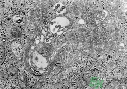 裂谷熱病怎么治？裂谷熱病的癥狀有哪些？