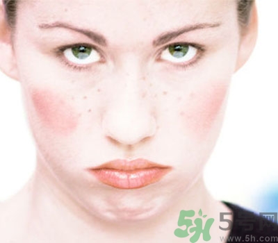 夏季流汗臉癢怎么回事？夏季臉癢怎么辦？