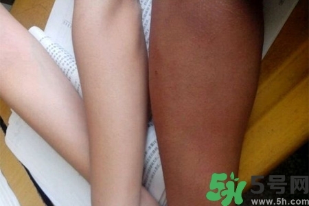 腿曬黑了怎么白回來？腿曬黑了怎么辦？