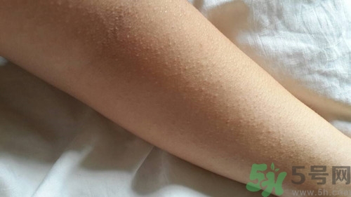 痱子怎么引起的?痱子怎么治療效果最快 痱子怎么引起的?痱子怎么治療效果最快