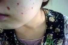 激光點痣后可以洗臉嗎？激光點痣后需要注意什么？