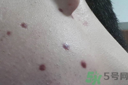 激光點痣后可以洗臉嗎？激光點痣后需要注意什么？