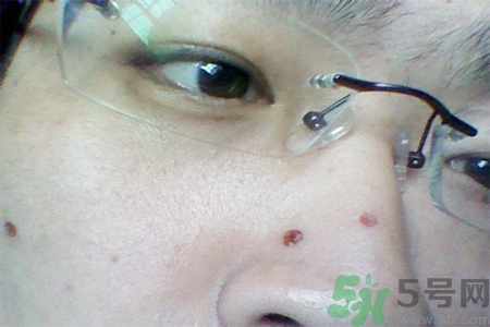 激光點(diǎn)痣后可以洗臉嗎？激光點(diǎn)痣后需要注意什么？