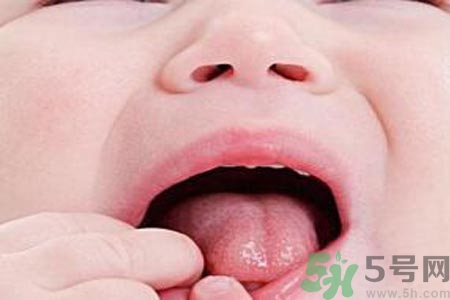 寶寶口腔潰瘍怎么辦？治療寶寶口腔潰瘍方法有什么？