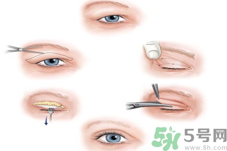 割雙眼皮分哪幾種？割雙眼皮需要多少錢(qián)？