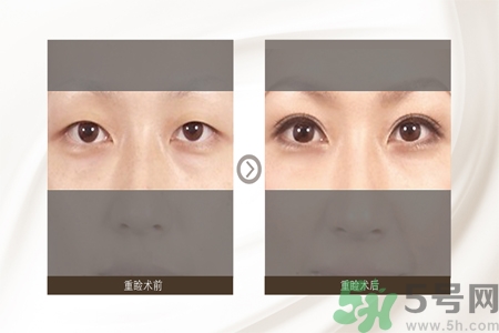 割雙眼皮分哪幾種？割雙眼皮需要多少錢？