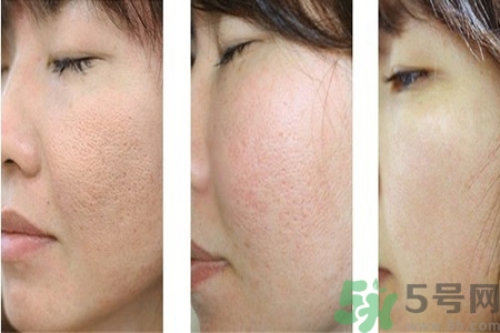 皮膚毛孔粗大原因有哪些？如何預(yù)防皮膚毛孔粗大？