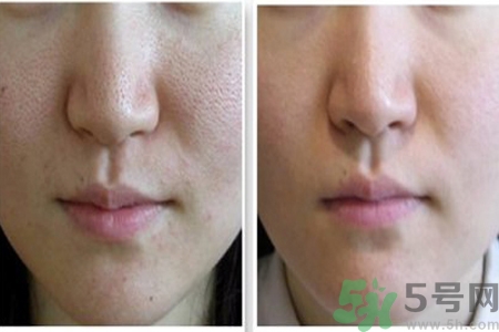 皮膚毛孔粗大原因有哪些？如何預(yù)防皮膚毛孔粗大？