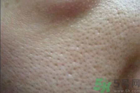 皮膚毛孔粗大原因有哪些？如何預(yù)防皮膚毛孔粗大？