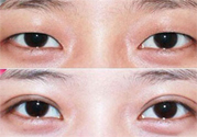 割雙眼皮分哪幾種？割雙眼皮需要多少錢？