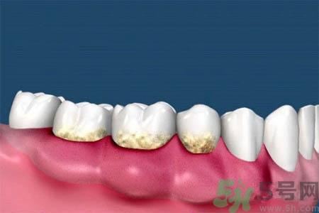 哪些人不能洗牙？洗牙需要注意什么？