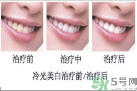 冷光美白牙齒是什么？冷光美白牙齒的好處有哪些？