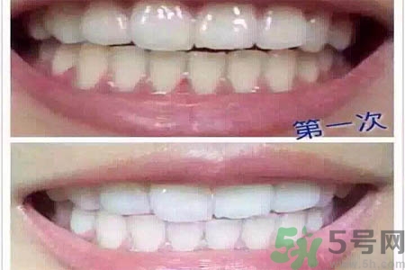 冷光美白牙齒的價格是多少？做冷光美白牙齒需要多少錢？