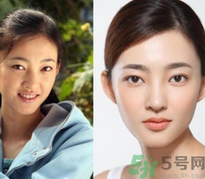 開眼角眼睛會(huì)變大嗎？開眼角眼睛能大多少？