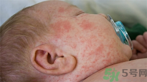 長痱子用花露水可以嗎?長痱子用什么好