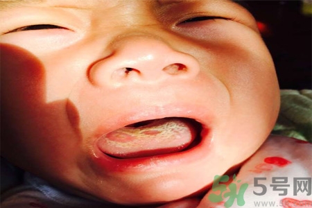 舌頭燙傷后該怎么辦呢？舌頭燙傷后應(yīng)該注意吃什么？?