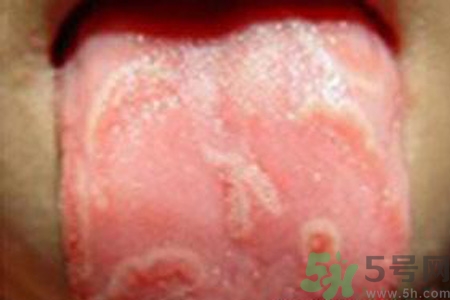 舌頭燙傷后該怎么辦呢？舌頭燙傷后應(yīng)該注意吃什么？?