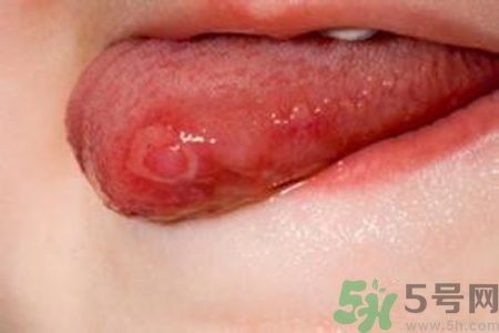 舌頭長泡怎么辦？舌頭長泡的原因？