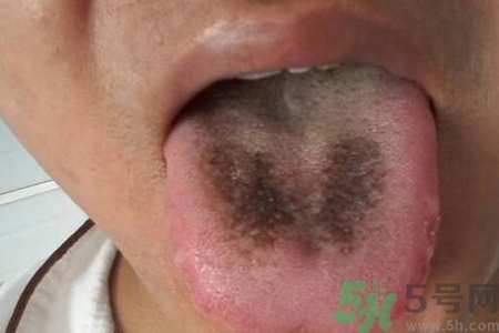 舌頭發(fā)黑怎么回事？舌頭發(fā)黑怎么辦？